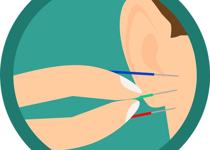 במה דיקור סיני יכול לעזור